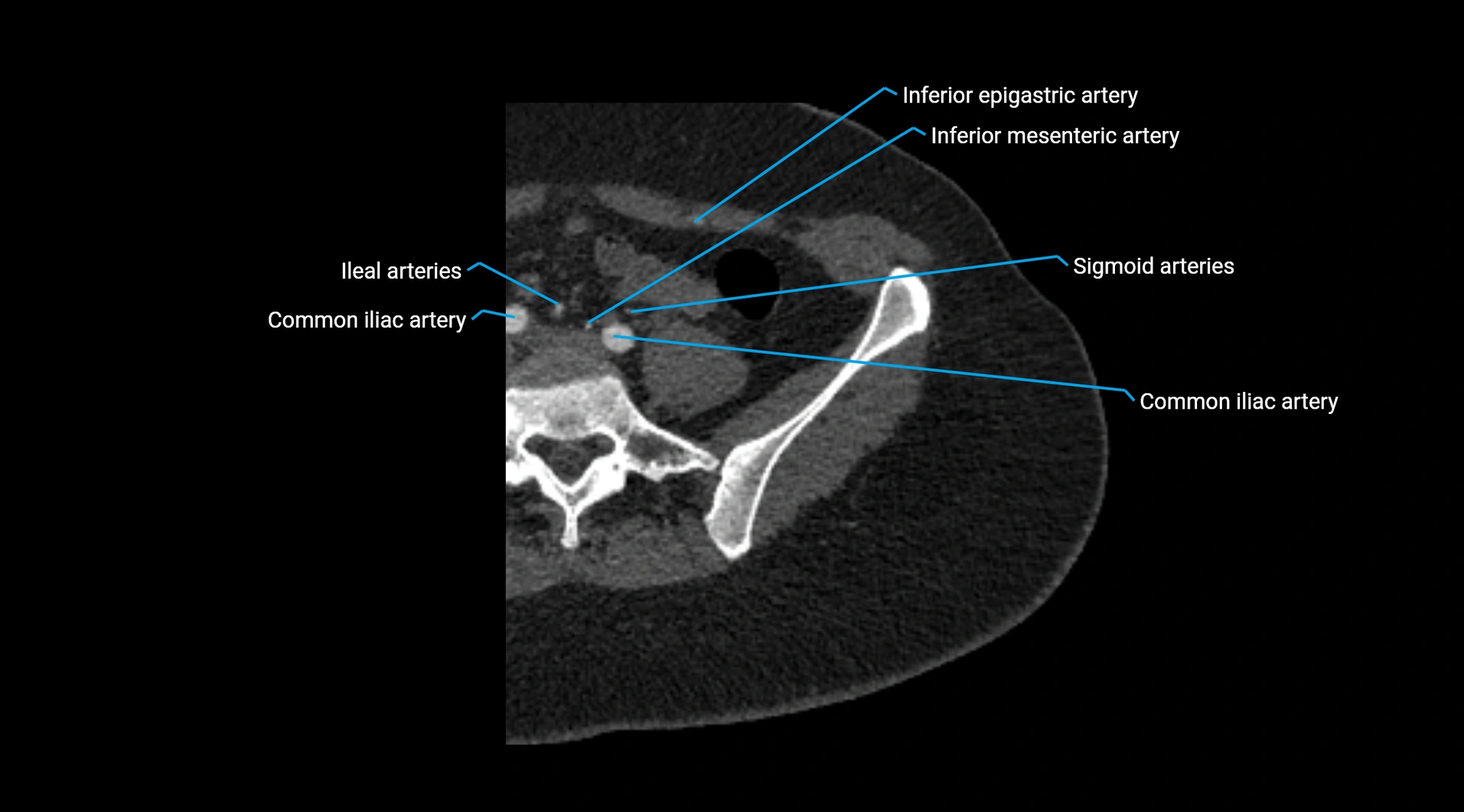 CTA lower limb cross sectional anatomy labelled image _12.webp